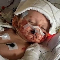 Baby Has Arms, Legs Amputated over Mystery Illness Baby Has Arms, Legs Amputated over Mystery Illness