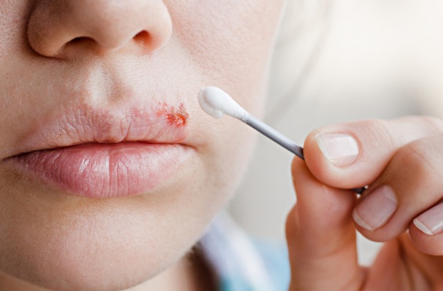 This Is What Really Causes Cold Sores